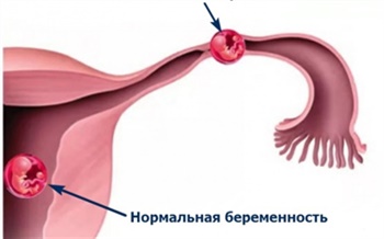 Красноярские врачи спасли женщину с двумя беременностями