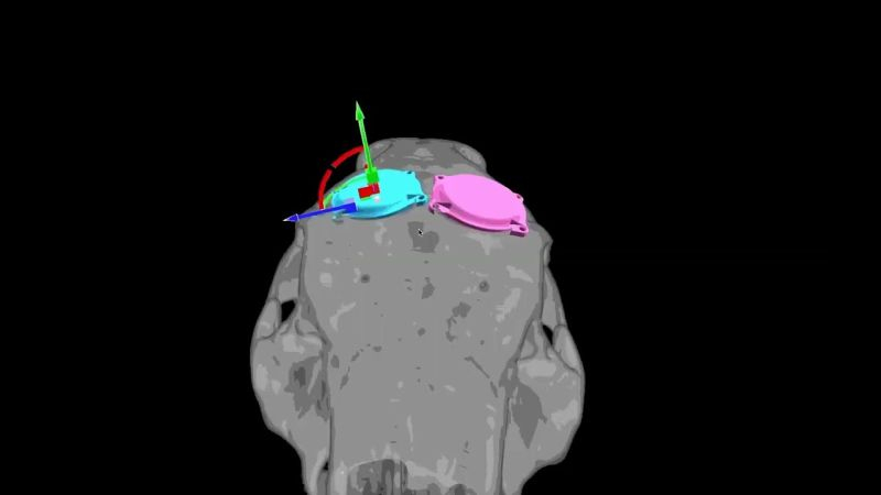 Neuralink успешно установила мозговой имплант третьему пациенту