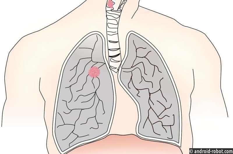 Метод искусственного интеллекта может улучшить прогнозирование мутаций генов при раке легких