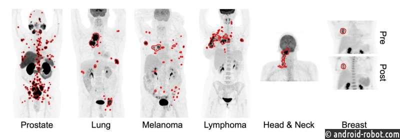 Новый инструмент искусственного интеллекта точно обнаруживает шесть различных типов рака