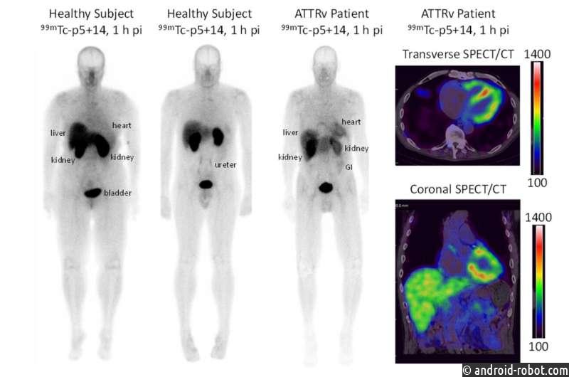 Новый радиофармпрепарат позволяет получить высококачественные изображения болезни сердца Альцгеймера