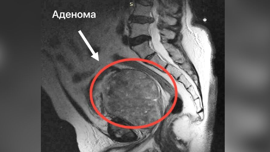 Россиянину удалили опухоль, из-за которой его простата увеличилась в 20 раз