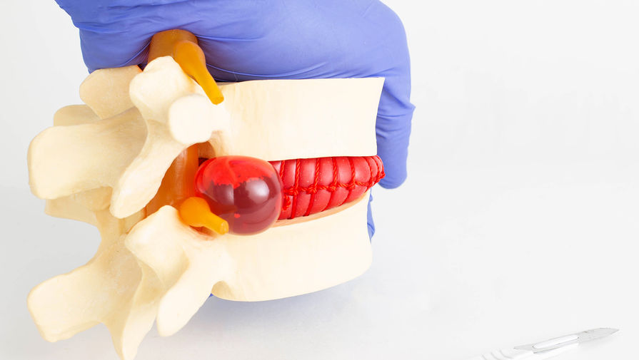 Создано необычное средство для облегчения боли после удаления грыжи