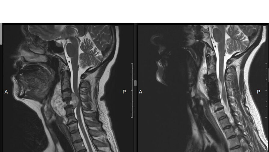 Врачи спасли россиянку, у которой опухоль разрушила позвонок и сдавила спинной мозг