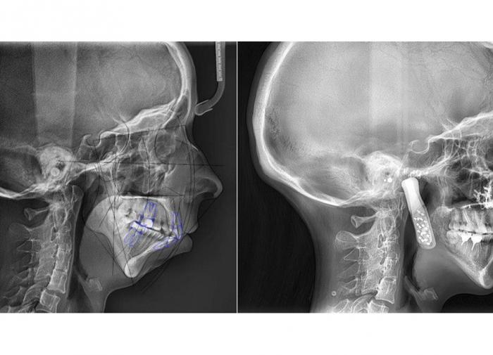 В Сеченовском университете разработан безопасный протез челюстного сустава