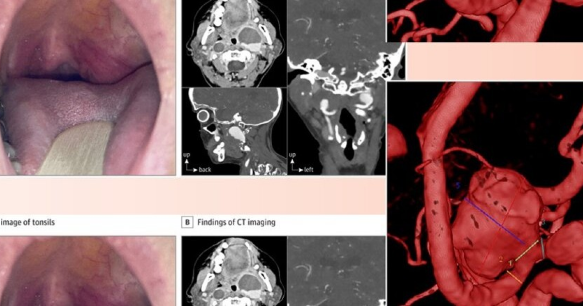 Боль в горле оказалась симптомом аневризмы сонной артерии у пожилой француженки