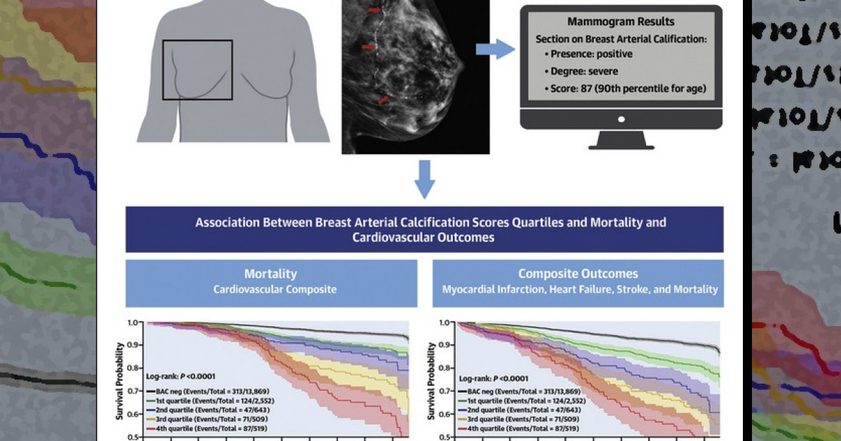 Кальцификацию артерий груди на маммограммах назвали биомаркером кардиологических рисков