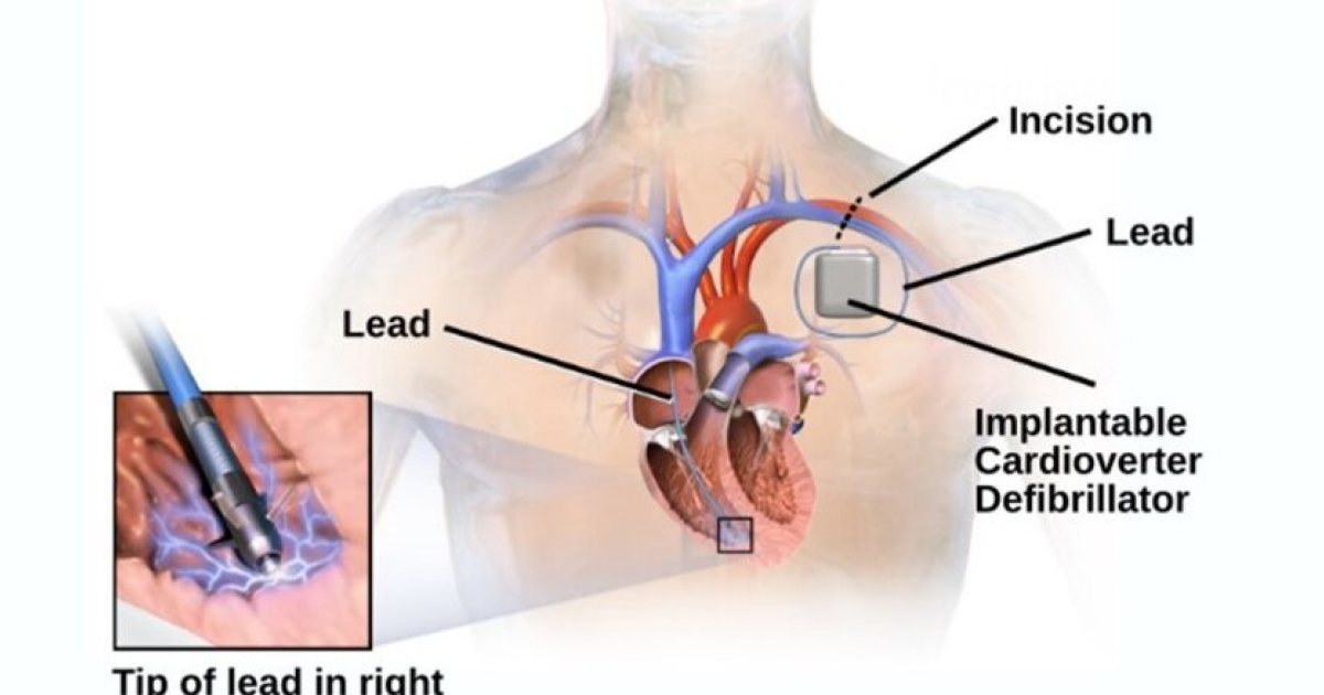 Кардиостимулятор лучше амиодарона защитил от сердечной смерти