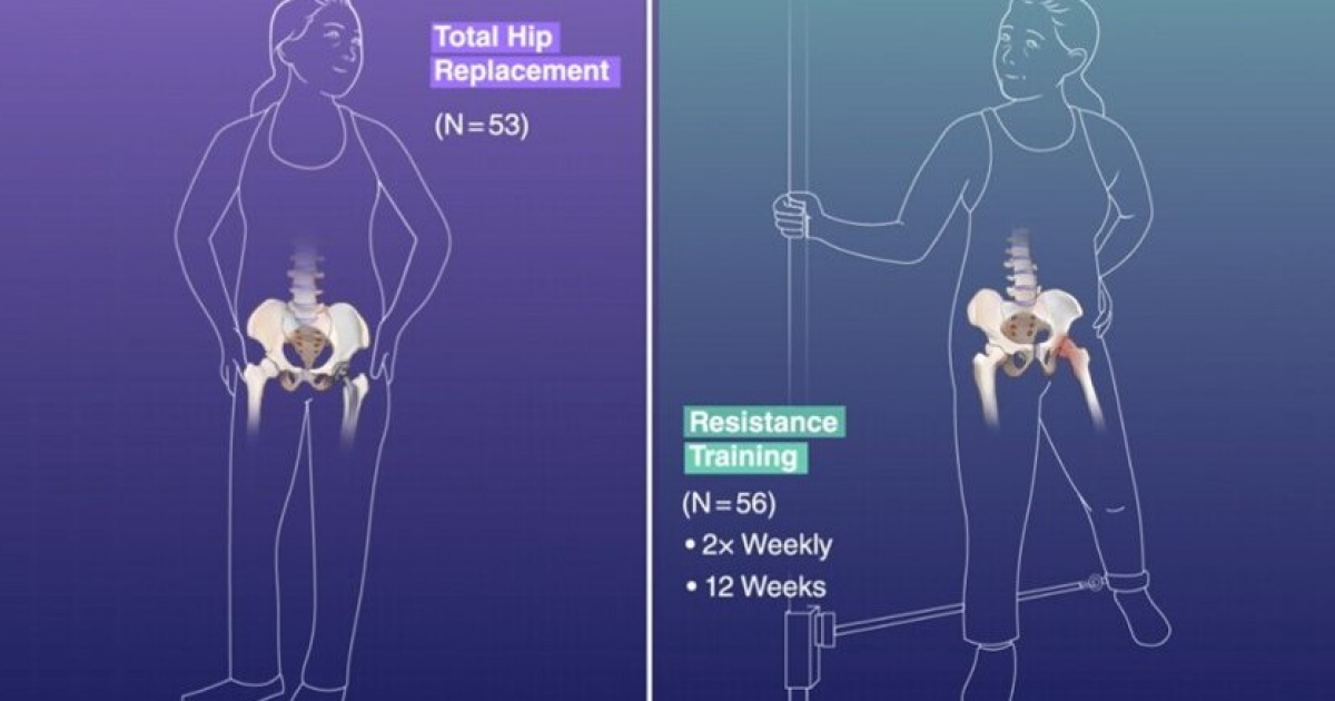 Замена тазобедренного сустава оказалась эффективнее физической реабилитации