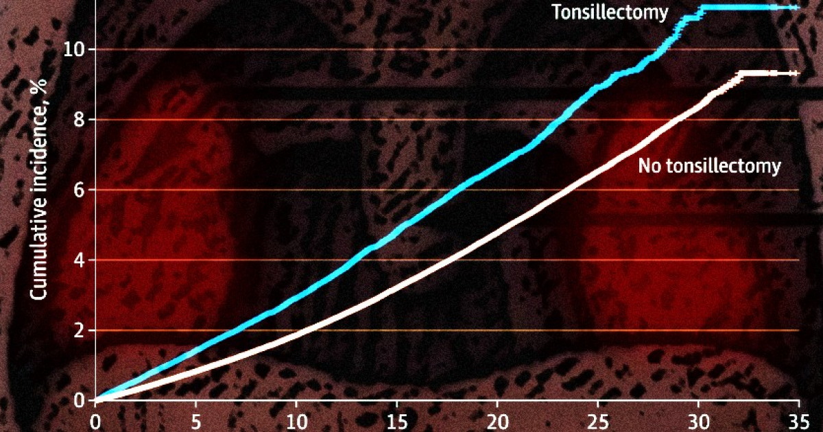 Удаление миндалин и аденоидов в детстве связали с ростом риска стрессовых расстройств