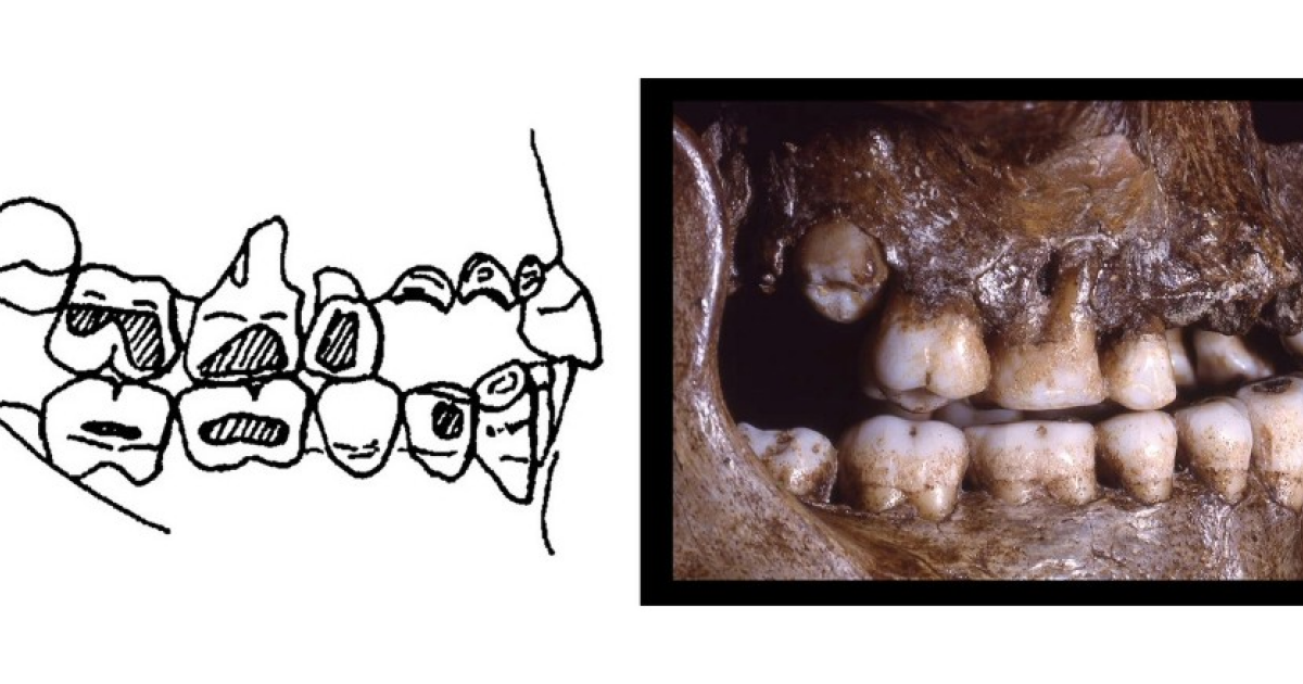 Повреждения на 30-тысячелетних зубах кроманьонцев объяснили пирсингом