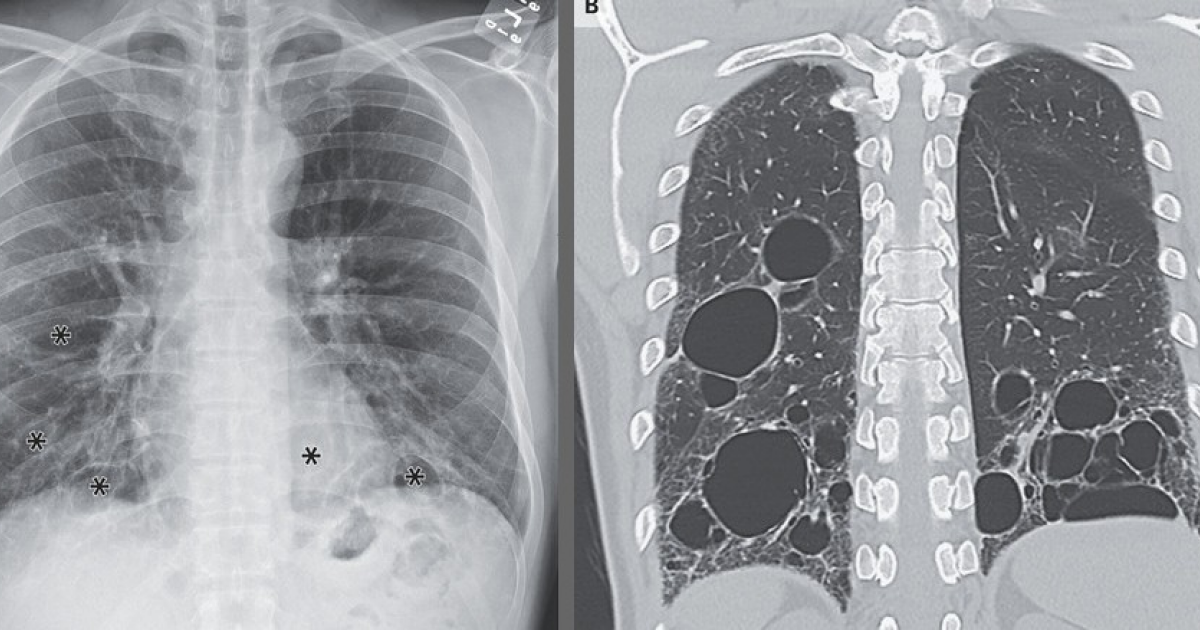 Синдром Шёгрена привел к крупным кистам в легких американца